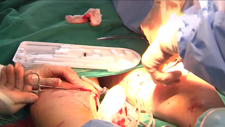 Việc phẫu thuật chữa yếu sinh lý đem lại hiệu quả tích cực, lâu dài 
