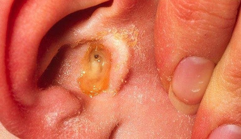 Viêm tai giữa ở người lớn