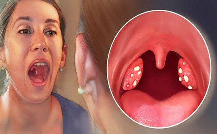 Thuốc Đông y trị viêm amidan hiệu quả, đảm bảo an toàn cao Thuốc Đông y trị viêm amidan hiệu quả, đảm bảo an toàn cao