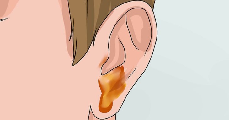 Ở mức độ nặng, bệnh nhân viêm tai giữa sẽ xuất hiện dịch vàng chảy ra từ trong tai