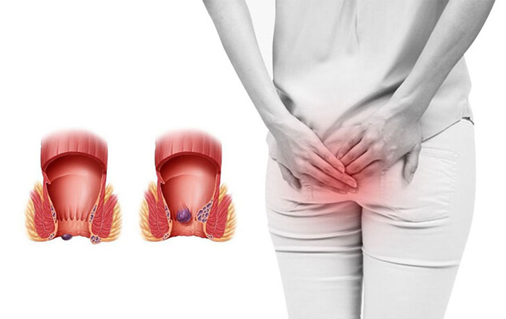 Trĩ là bệnh phổ biến hiện nay với các triệu chứng khó chịu Trĩ là bệnh phổ biến hiện nay với các triệu chứng khó chịu