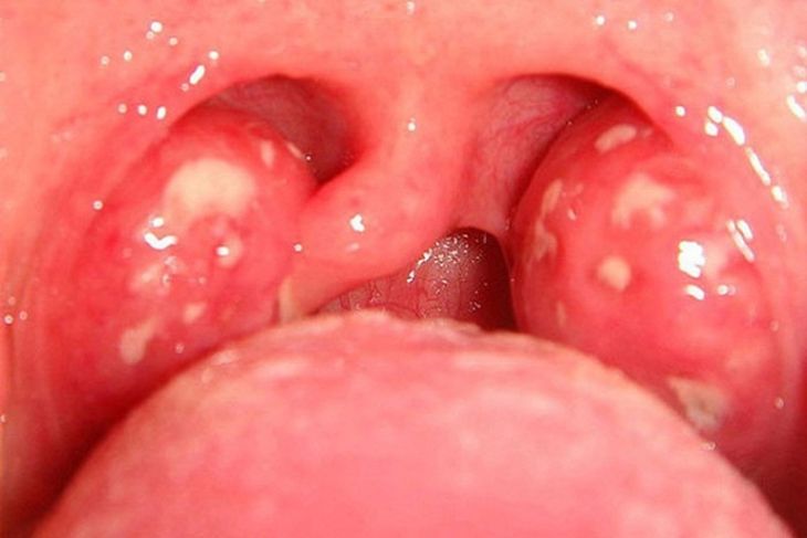 Viêm amidan nếu được áp dụng chế độ dinh dưỡng hợp lý sẽ cải thiện nhanh chóng