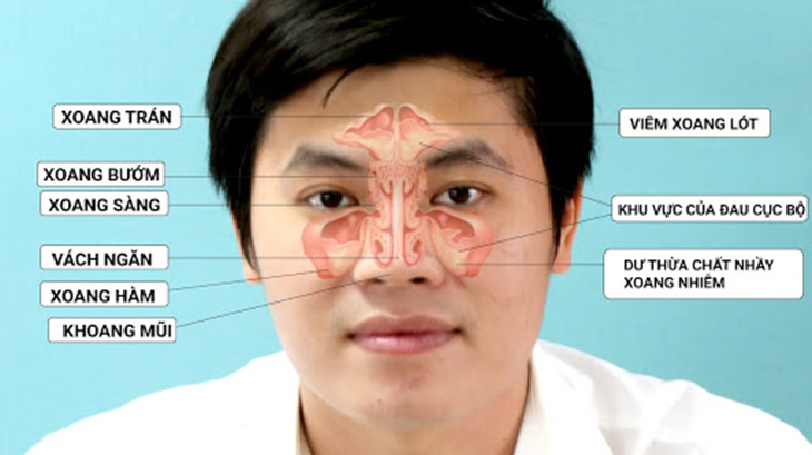 Viêm đa xoang là tình trạng nhiễm trùng ở nhiều xoang