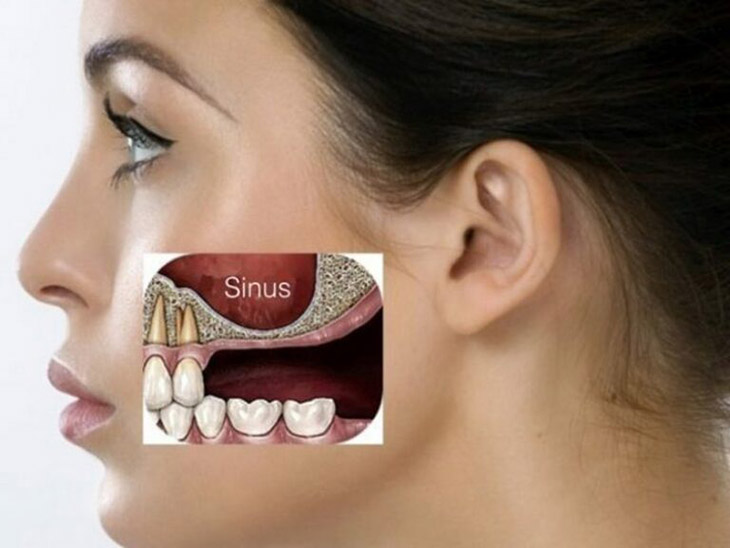 Người bệnh thường bị đau nhức dữ dội tại má, sốt cao do nhiễm khuẩn, có thể chảy mủ ở mũi và hôi miệng
