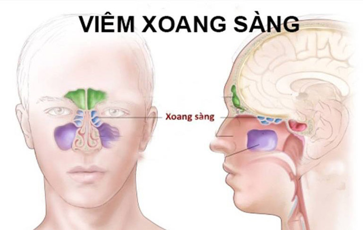 Người bị viêm xoang sàng thường bị đau nhức từ đầu đến gáy