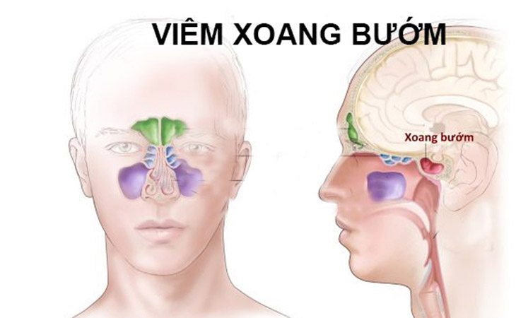 Người bệnh thường bị phù nề niêm mạc xoang, đau từ đầu ra sau gáy
