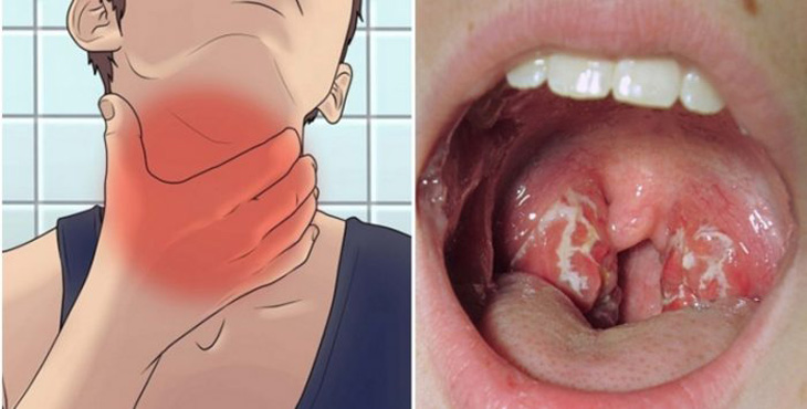 Viêm amidan có đốm trắng khiến người bệnh mệt mỏi, sốt, kèm theo nhiều triệu chứng khác