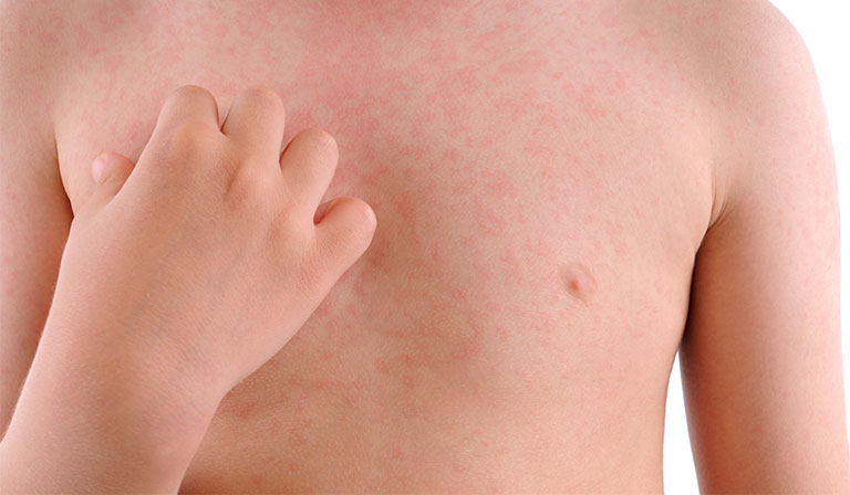 Hãy tránh xa các yếu tố gây nổi mề đay