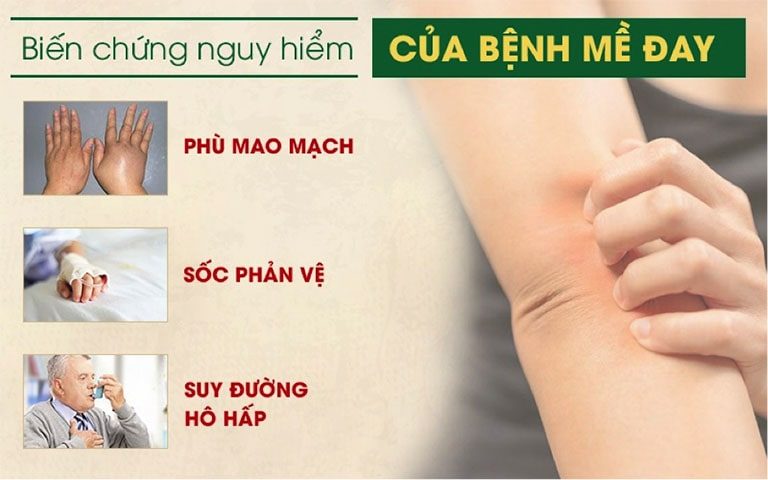 Bệnh nổi mề đay có thể có những biến chứng nguy hiểm