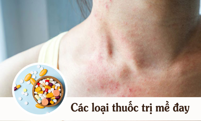 Cách điều trị nổi mề đay bằng thuốc Tây có hiệu quả không?