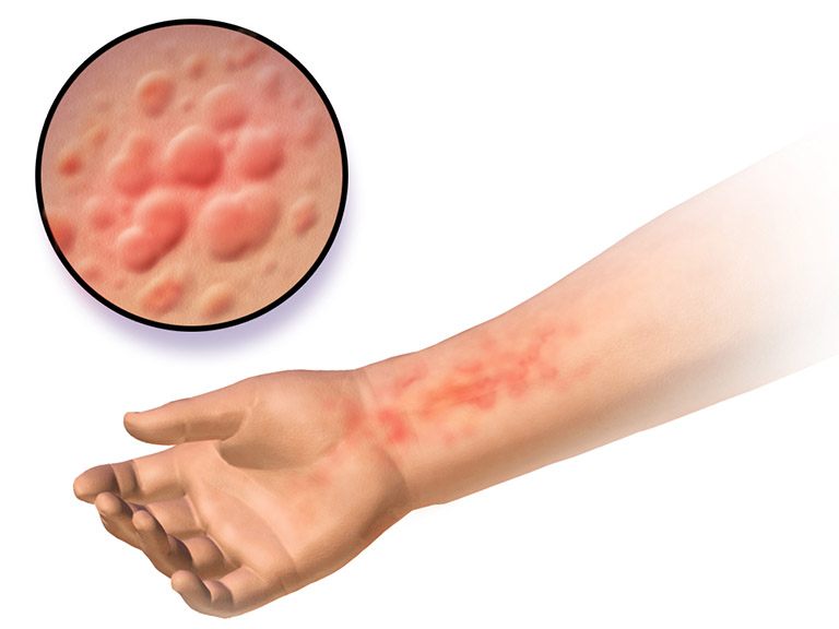 Nổi mẩn đỏ ngứa rát là triệu chứng do uống rượu nổi mề đay