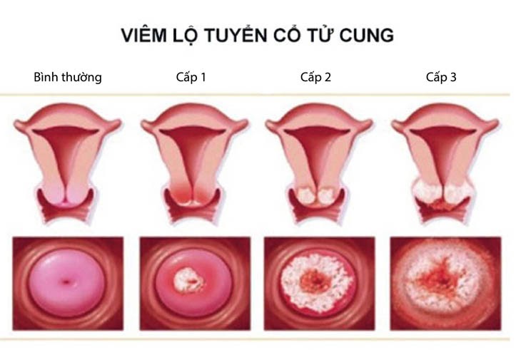 Đốt viêm lộ tuyến cổ tử cung thường áp dụng khi bệnh ở mức độ 2, 3