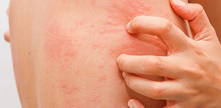 Ngứa da toàn thân có thể trị khỏi bằng thuốc Tây không?