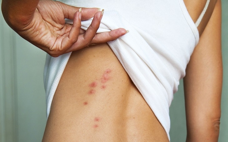 Các cách trị ngứa da toàn thân có thể bạn chưa biết