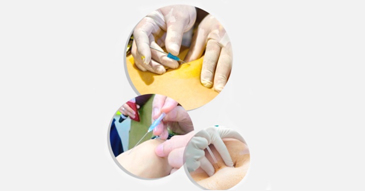 Ưu, nhược điểm của phương pháp cấy chỉ nano