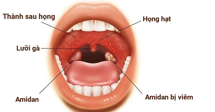 Điều trị viêm amidan bằng phương pháp diện chẩn được nhiều người bệnh tin tưởng sử dụng
