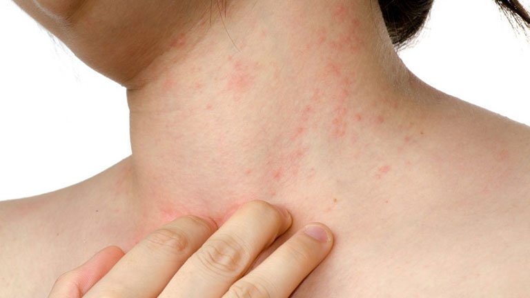 Giải đáp lo ngại: Bệnh mề đay có lây không?