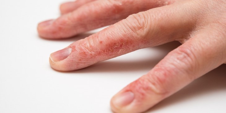 Lột da tay bị ngứa do viêm da tiếp xúc là căn bệnh dễ mắc, khó chữa