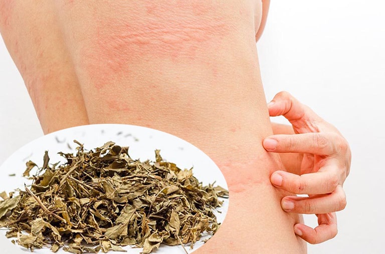 Lá khế trị mề đay là bài thuốc dân gian được dùng phổ biến