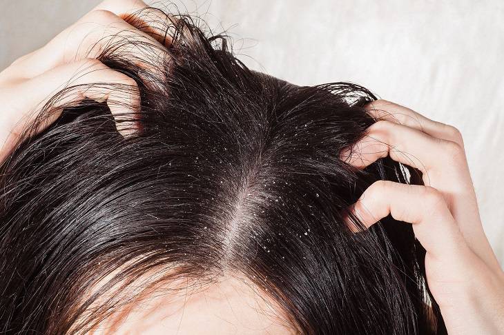 Gàu là một trong những nguyên nhân hàng đầu gây ngứa da đầu dữ dội