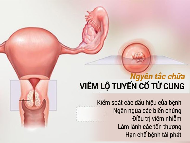 Nguyên tắc chữa viêm lộ tuyến cổ tử cung giúp loại trừ tận gốc