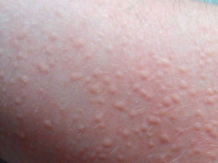 Nổi mề đay là căn bệnh ngoài da phổ biến hàng đầu Việt Nam