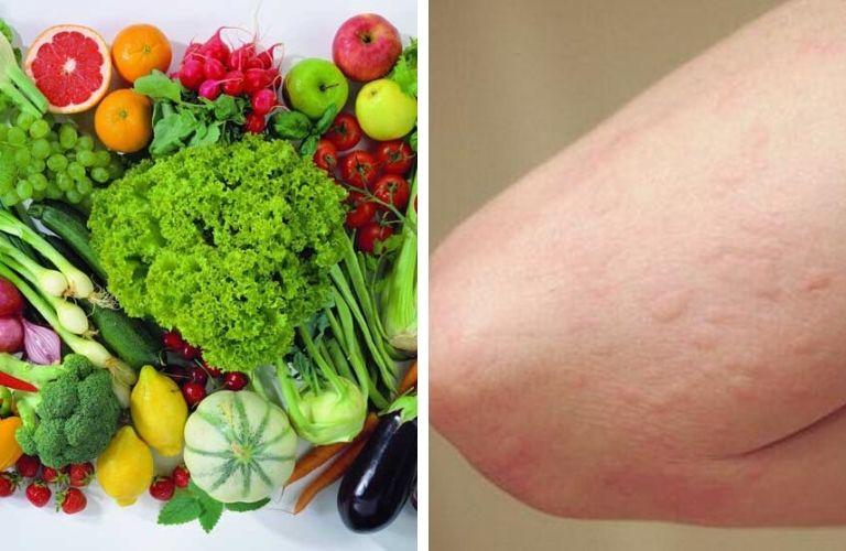 Trẻ bị mề đay kiêng gì để nhanh khỏi bệnh?