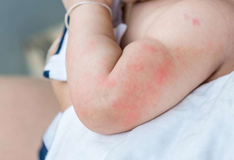 Kiêng khem đúng cách để ngăn ngừa bệnh 