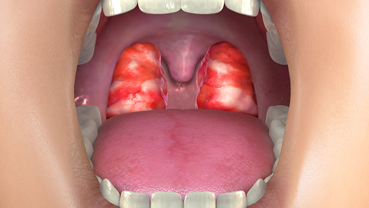 Hình ảnh amidan bị viêm, sưng