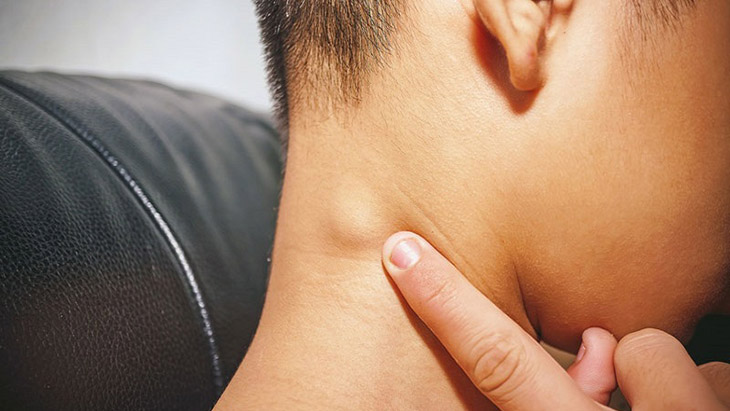 Viêm amidan cũng có thể khiến trẻ bị nổi hạch cổ