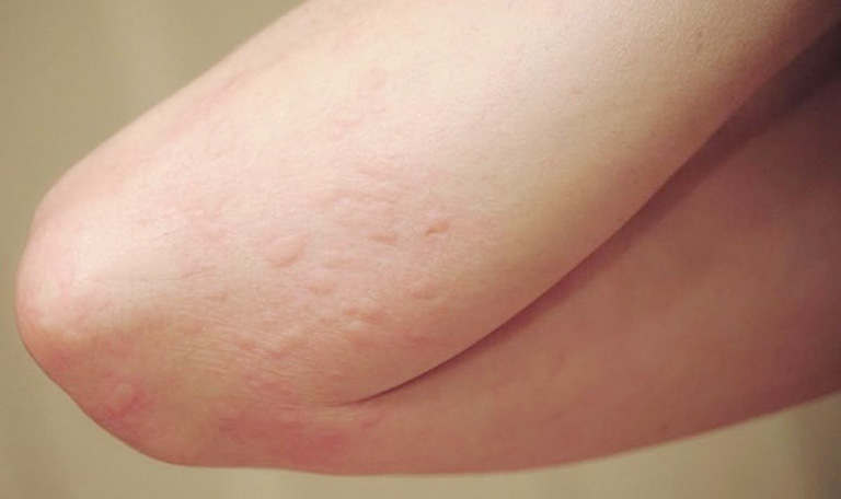 Cách trị mề đay bằng lá khế chỉ áp dụng khi bệnh nhẹ