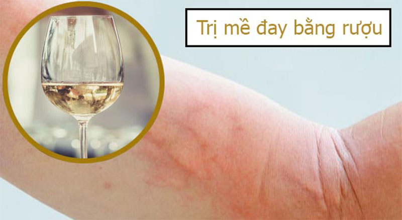 Trị mề đay bằng rượu có ưu điểm gì, cùng tìm hiểu