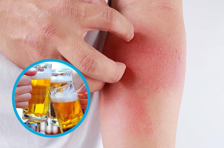 Nguyên nhân uống rượu bia gây nổi mề đay
