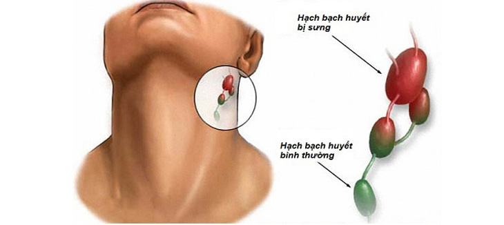 Viêm amidan có nổi hạch ở cổ không được nhiều người bệnh quan tâm
