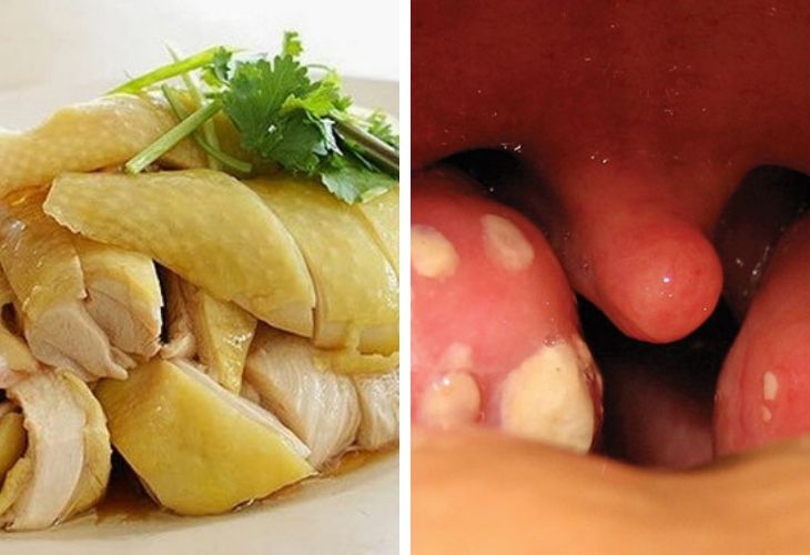 Viêm amidan có được ăn thịt gà không là thắc mắc của nhiều bệnh nhân hiện nay