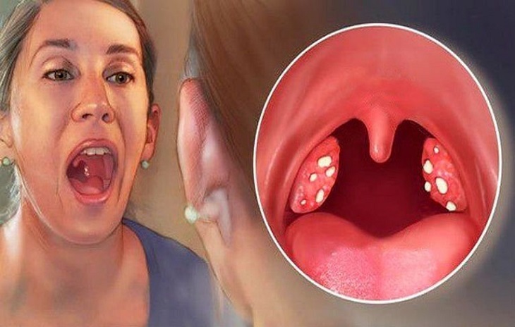Viêm họng loét nghiêm trọng hơn nhiều so với viêm họng thông thường