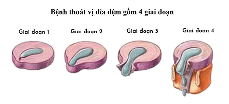 Thoát vị đĩa đệm chia làm 4 giai đoạn