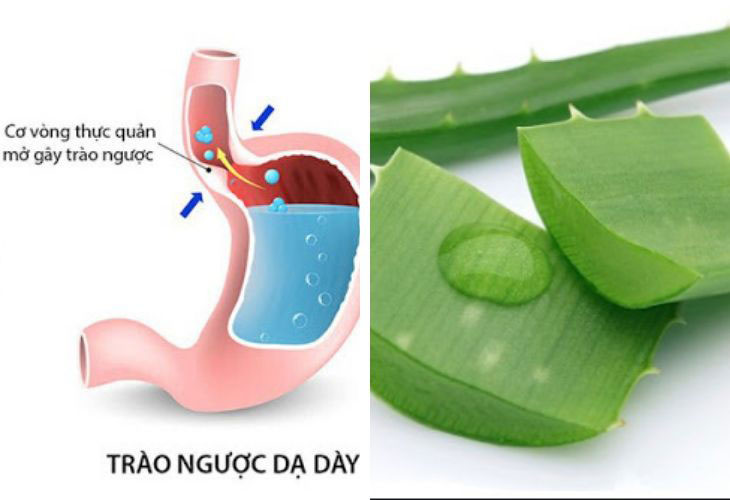 Bài thuốc chữa trào ngược dạ dày bằng nha đam