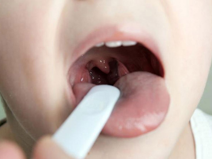 Viêm họng là hậu quả thường gặp ở người bị viêm xoang