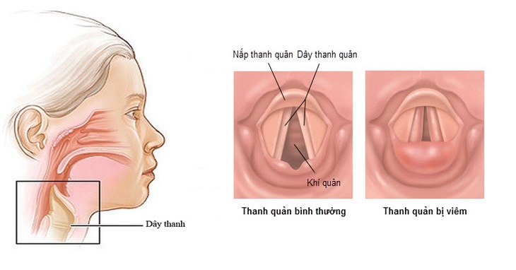 Hình ảnh thanh quản bị viêm