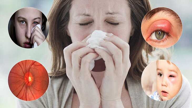 Các biến chứng của viêm xoang về mắt
