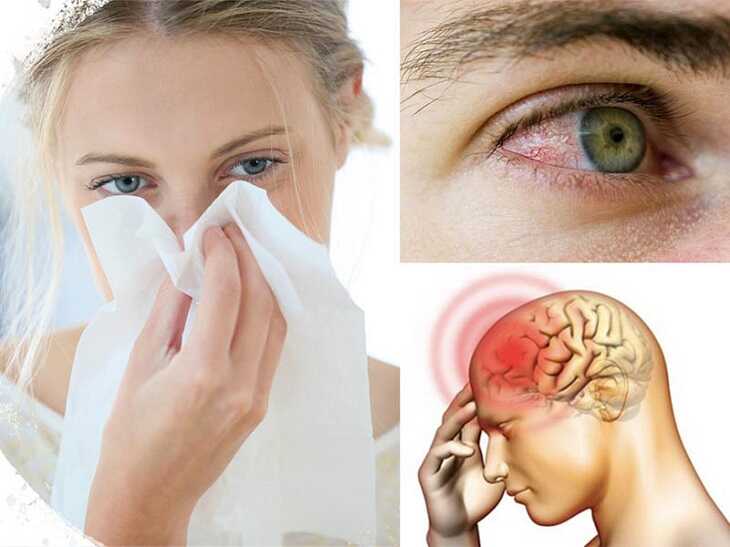 Một số biến chứng mắt và não của viêm xoang
