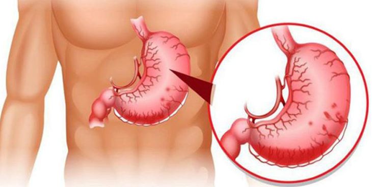 Bệnh nhân bị xuất huyết dạ dày nhẹ sẽ cần nằm viện trong khoảng 1 tuần