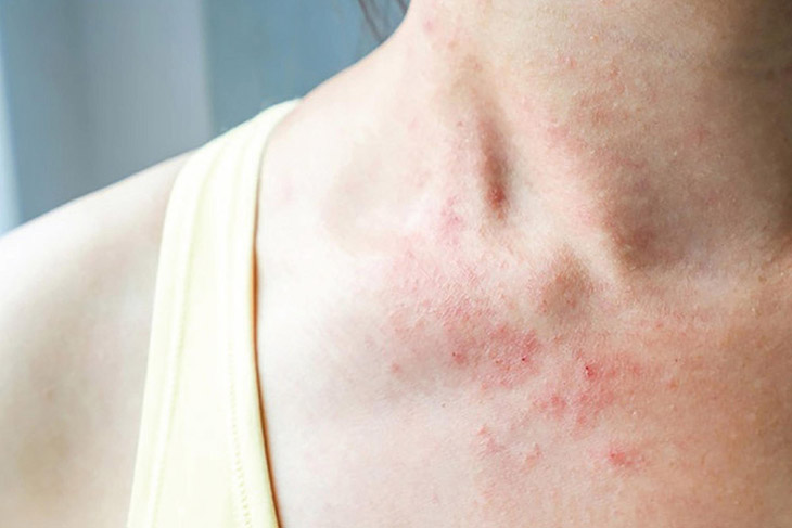 Viêm da cơ địa gây nổi mẩn ngứa ở cổ