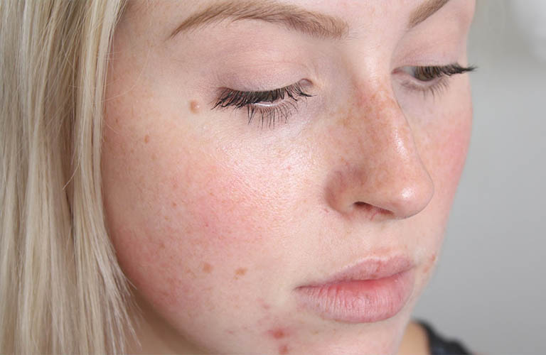 Viêm da dị ứng ở mặt gây nổi mẩn đỏ Viêm da dị ứng ở mặt gây nổi mẩn đỏ