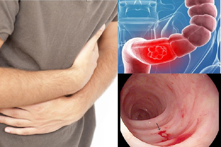 Có nhiều nguyên nhân gây chảy máu đại tràng