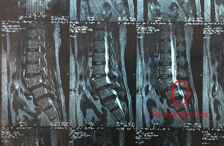 Phim chụp Mri thể hiện ống sống bị hẹp vì khối thoát vị