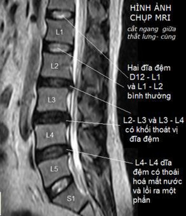 Phim chụp Mri đoạn đốt sống thắt lưng