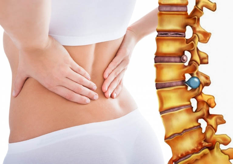 Thoát vị là căn bệnh nguy hiểm cần được điều trị sớm