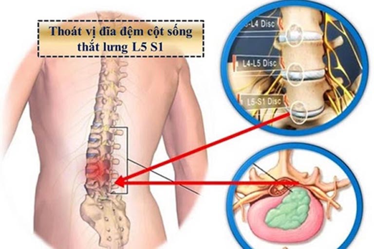 Tìm hiểu cách chữa thoát vị đĩa đệm bằng bài thuốc dân gian